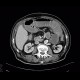 Upside-down stomach, small bowel obstruction, ileus, retained contrast in colonic diverticula: CT - Computed tomography